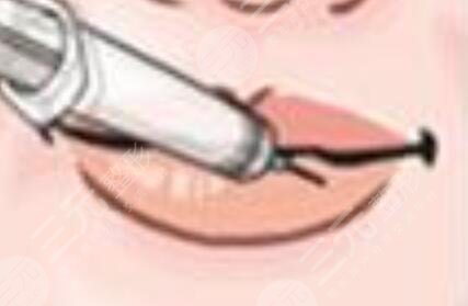 紋唇一到七天恢復過程參考：嘟嘟唇好看誘人~
