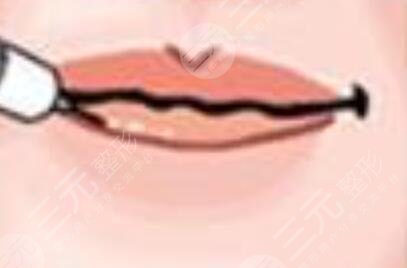 紋唇前的狀況