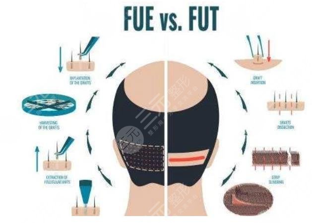 FUE種植頭發(fā)技術(shù)