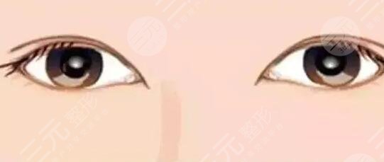 林煌醫(yī)生雙眼皮整形案例1：