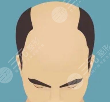 西安熙朵植發(fā)醫(yī)院頭發(fā)種植案例分享