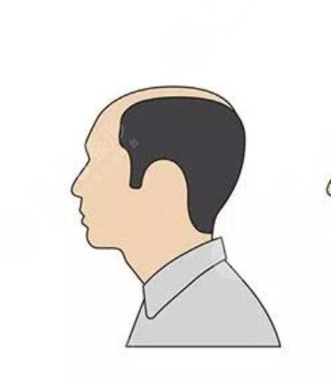 嘉興植發(fā)醫(yī)院哪個好