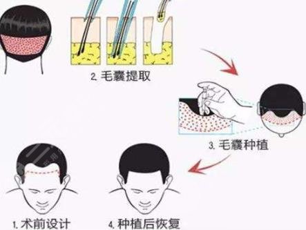 6000元植發(fā)手術(shù)術(shù)后