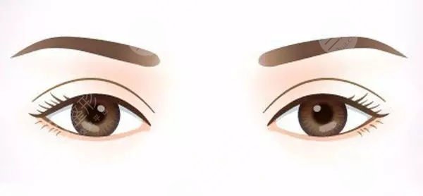 成都悅好陳國雙雙眼皮做得怎么樣 真實案例分享