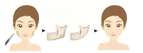 黃旭培在磨骨改臉型手術過程