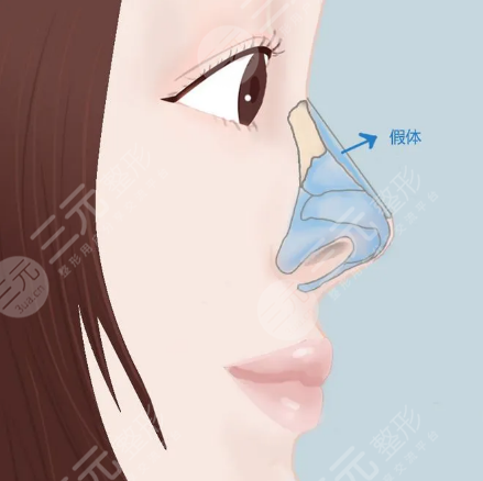 北京悅?cè)会t(yī)療李京霖醫(yī)生怎么樣？隆鼻果圖魅力呈現(xiàn)！