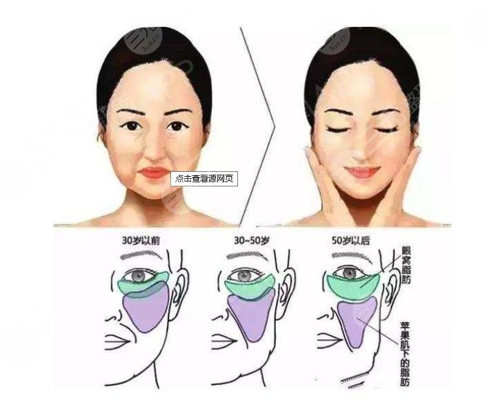 v美減齡后遺癥|輕微浮腫別擔(dān)心!手術(shù)原理+術(shù)后護(hù)理盤(pán)點(diǎn)~