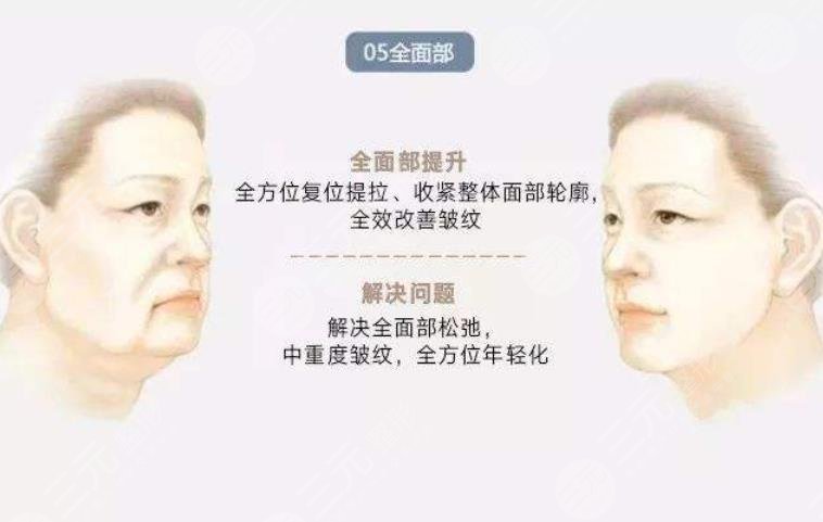 v美減齡術(shù)后的護(hù)理