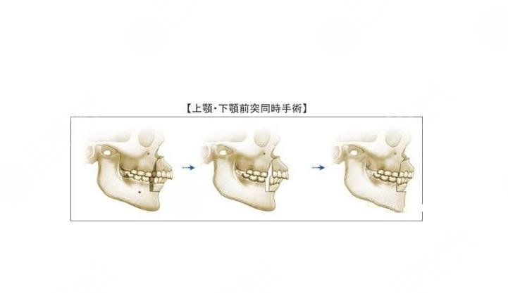 武漢大學(xué)口腔醫(yī)院正頜案例