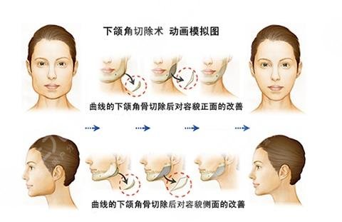 下頜角切除的價錢
