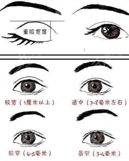 雙眼皮修復(fù)手術(shù)
