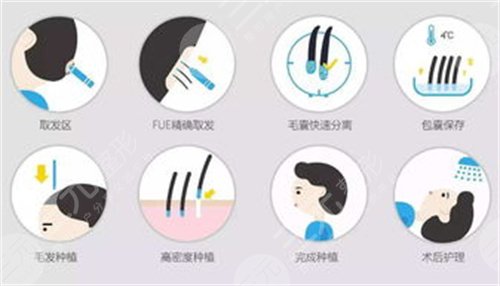蘇州新生植發(fā)醫(yī)院大面積植發(fā)案例分享