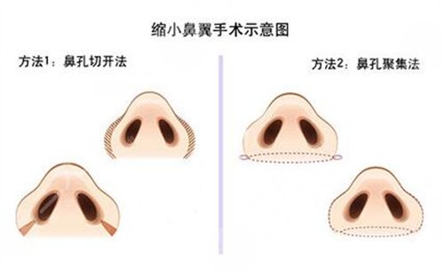 隆鼻手術案例分享