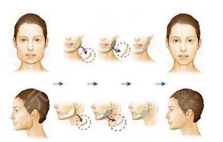 張笑天醫(yī)生下頜角磨骨手術(shù)案例分享