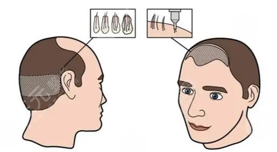 合肥叢生植發(fā)醫(yī)院頭發(fā)加密手術(shù)分享