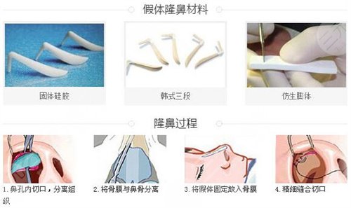廣州隆鼻案例分享
