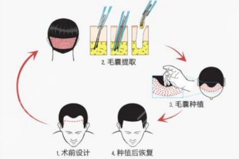 東莞美立方植發(fā)中心發(fā)際線種植分享