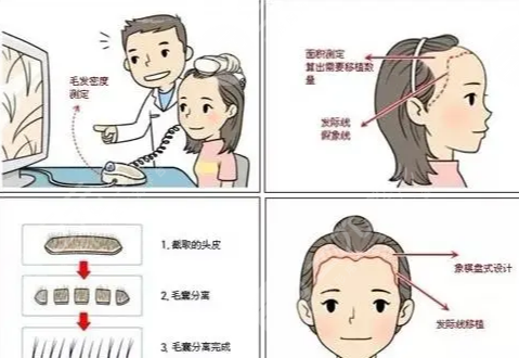 北京碧蓮盛植發(fā)醫(yī)院發(fā)際線種植案例