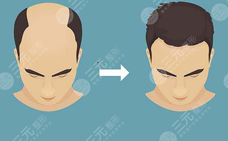 北京碧蓮盛植發(fā)醫(yī)院發(fā)際線種植案例