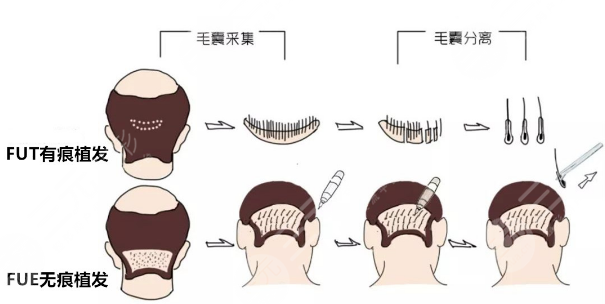 北京碧蓮盛植發(fā)醫(yī)院發(fā)際線種植案例