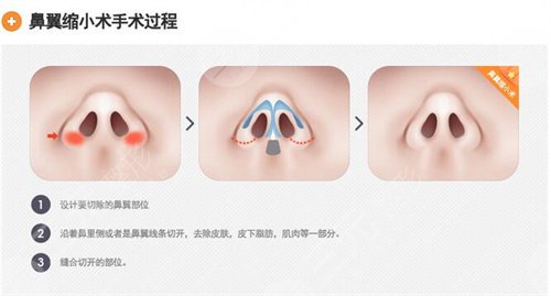 懷化天姿整形2019全新價格表詳覽及隆鼻整形案例分享