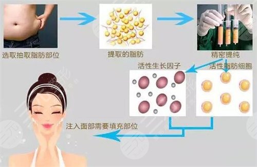 2019株洲愛思特整形全新價格表曝光及自體脂肪填充案例分享