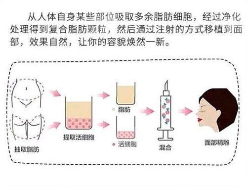 2019株洲愛思特整形全新價格表曝光及自體脂肪填充案例分享