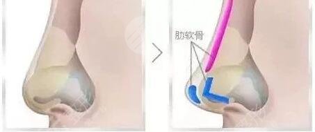 羅匯東隆鼻項(xiàng)目介紹