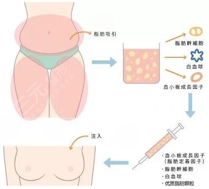 重慶新橋醫(yī)院樊東力吸脂