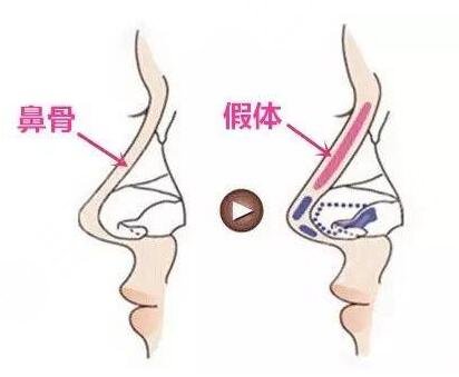 李長賦做鼻子10萬夠嗎？做鼻子多少錢？