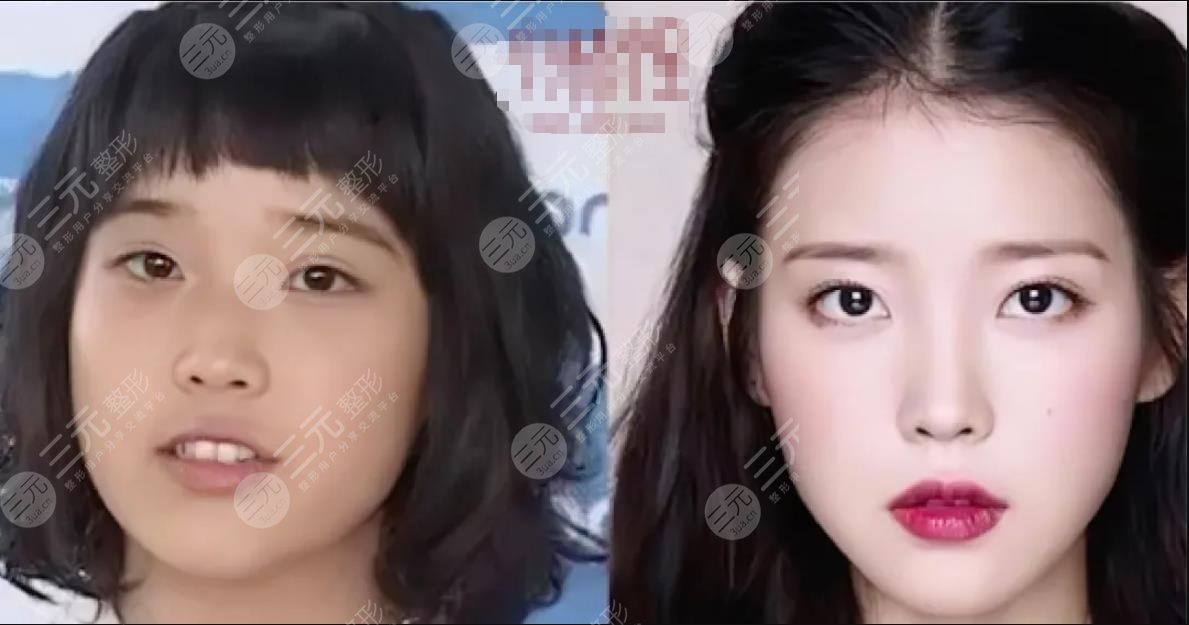 顏值分析|IU李知恩變美思路？不動骨微調也能變女神！整容史盤點！