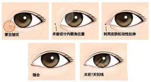 和平醫(yī)院整形外科開眼角多少錢？價格明細+真實開眼角案例~