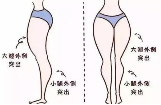 北京佰嘉利醫(yī)療美容吸脂瘦大腿案例