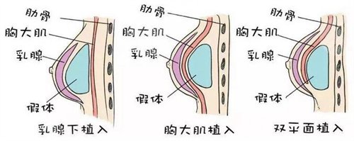 董佳生隆胸案例前