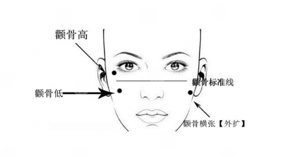 顴骨縮小術(shù)幾天恢復(fù) 顴骨縮小術(shù)恢復(fù)圖