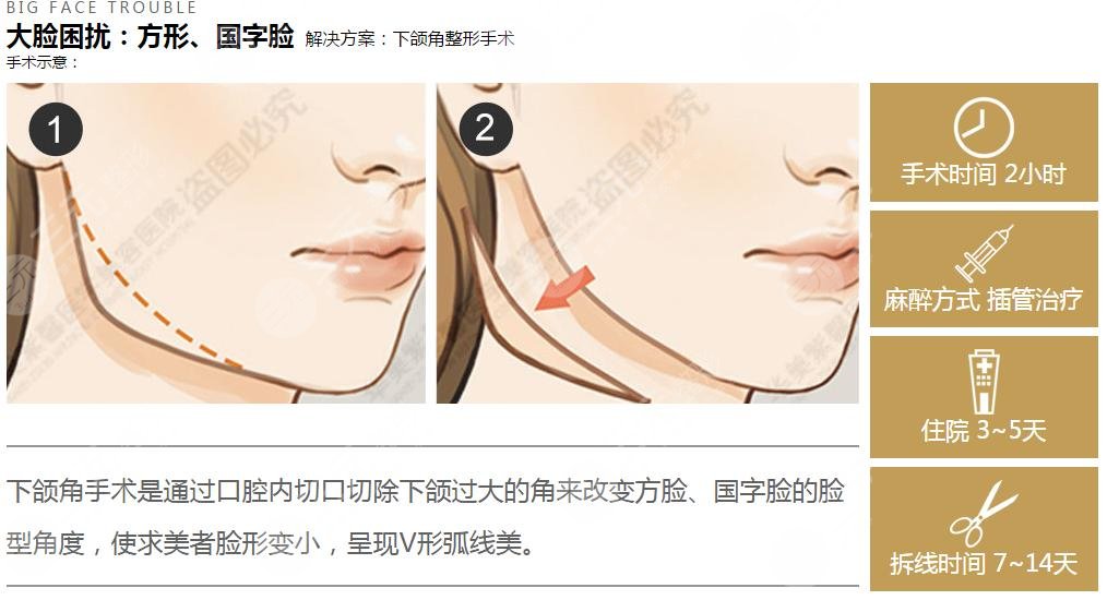 顴骨縮小術(shù)幾天恢復(fù) 顴骨縮小術(shù)恢復(fù)圖