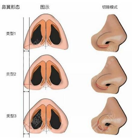 蘇北整形美容科2021新版價(jià)目表，鼻翼縮小手術(shù)案例