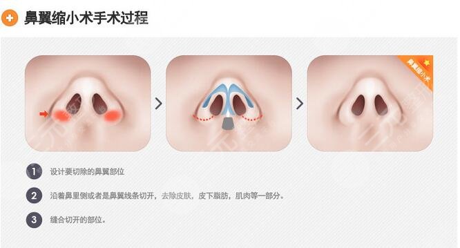 蘇北整形美容科2021新版價(jià)目表，鼻翼縮小手術(shù)案例