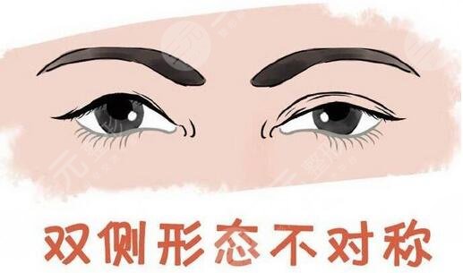 上海九院整形科雙眼皮案例