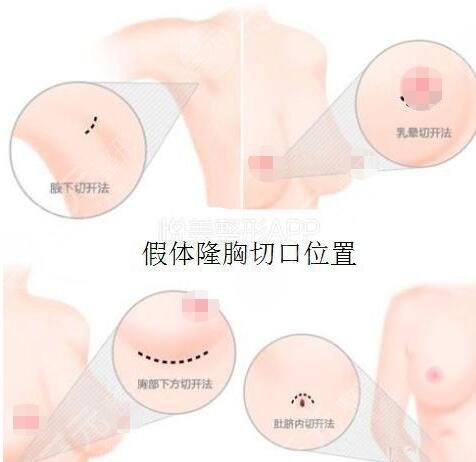 上海九院假體隆胸案例