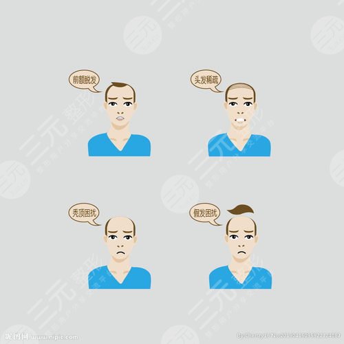 廈門銀河禿頂加密植發(fā)案例分享