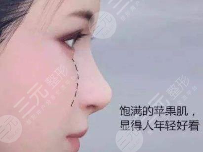 蘋果肌