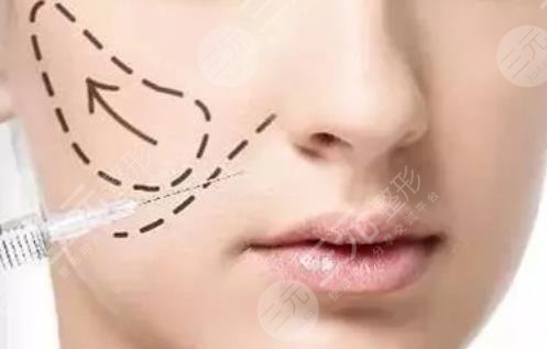 蘋(píng)果肌