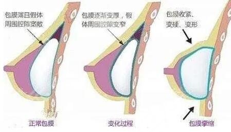 毛面假體和光面假體哪個(gè)好?
