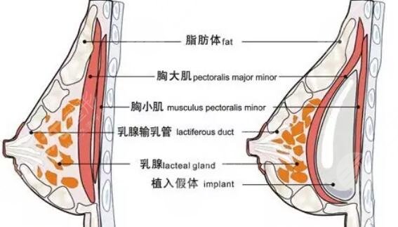 硅膠隆胸手術(shù)有危害嗎?