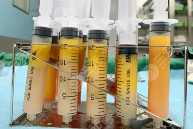 二次冷凍脂肪填充可靠嗎？