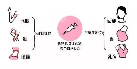 二次冷凍脂肪填充技術(shù)原理