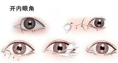 開眼角手術(shù)和不開眼角的區(qū)別