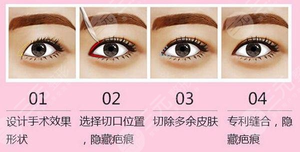 開眼角手術(shù)和不開眼角的區(qū)別