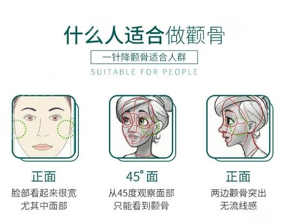 顴骨整形